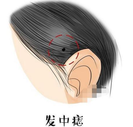 女人發(fā)中長痣代表什么