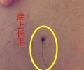 痣毛剪掉會(huì)影響運(yùn)氣嗎，破壞運(yùn)氣的痣長(zhǎng)在哪里