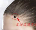 頭發(fā)邊緣有痣代表什么，發(fā)際線上有痣命運(yùn)如何